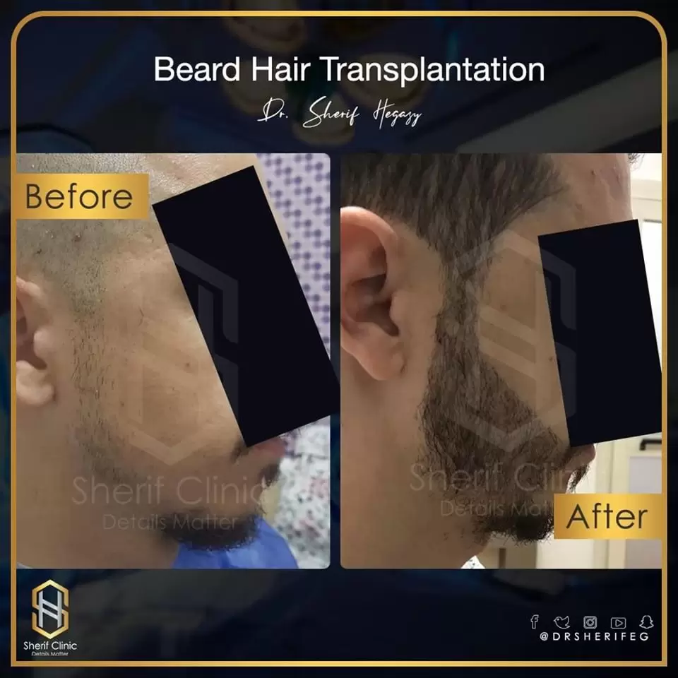 زراعة شعر الذقن