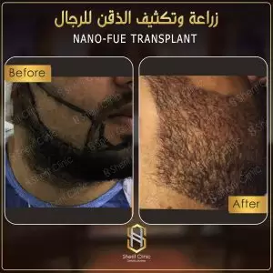 زراعة شعر الذقن