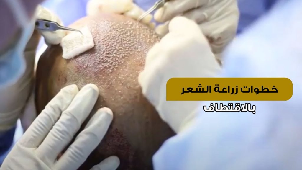 خطوات زراعة الشعر الطبيعي بالفيديو