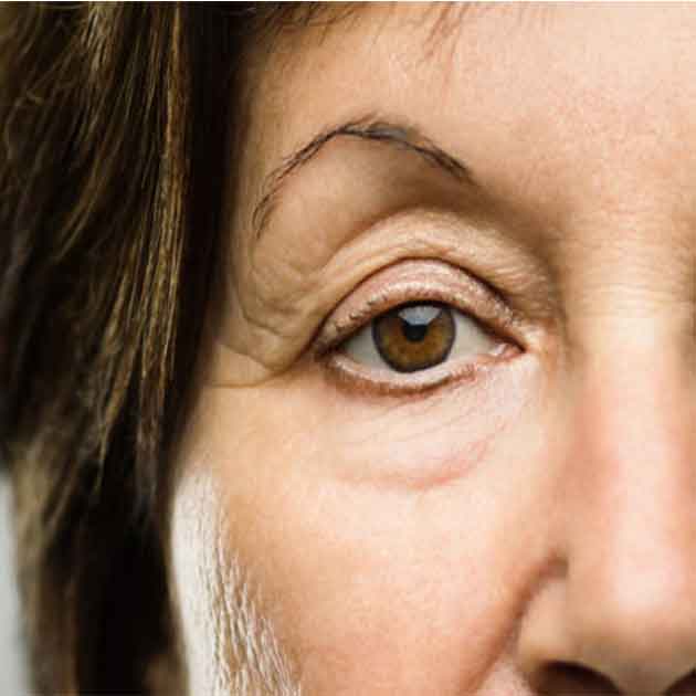 علاج ارتخاء جفن العين طبيعيا