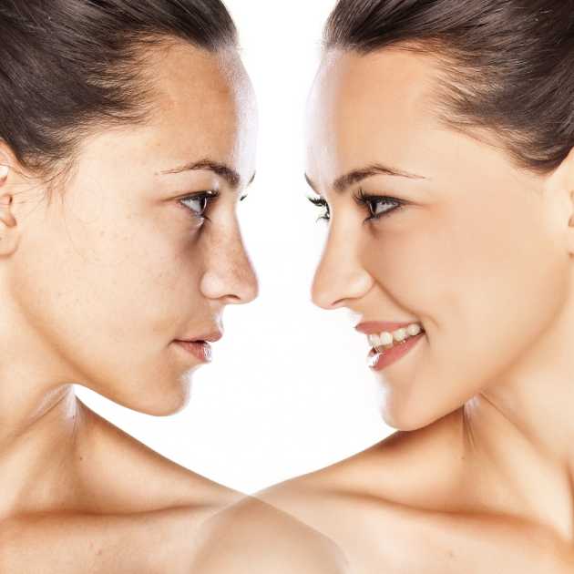 عملية حقن الدهون في الوجه