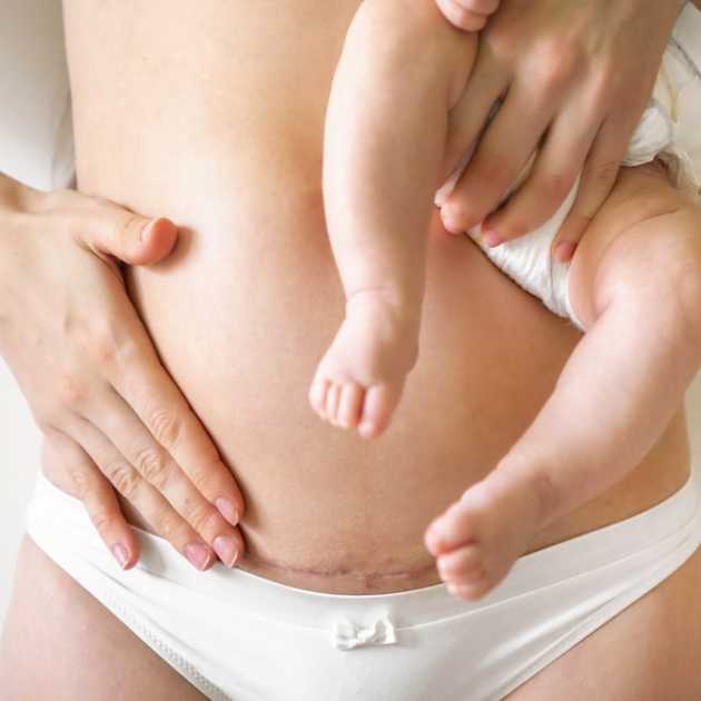 عمليات شفط الدهون اثناء الولادة