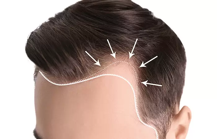 تكلفة زراعة الشعر