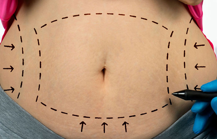 شفط الدهون بعد الولادة