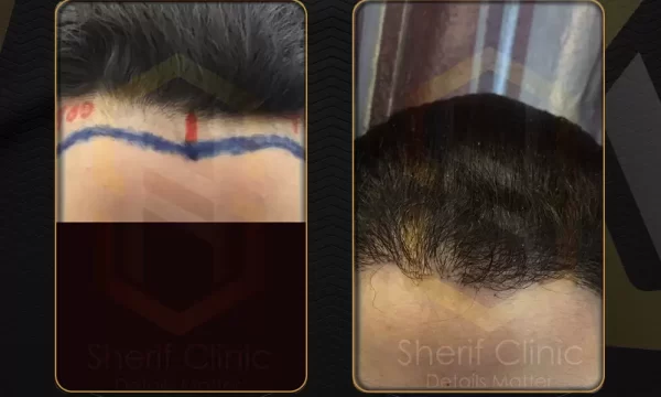 نتائج زراعة الشعر للنساء قبل وبعد
