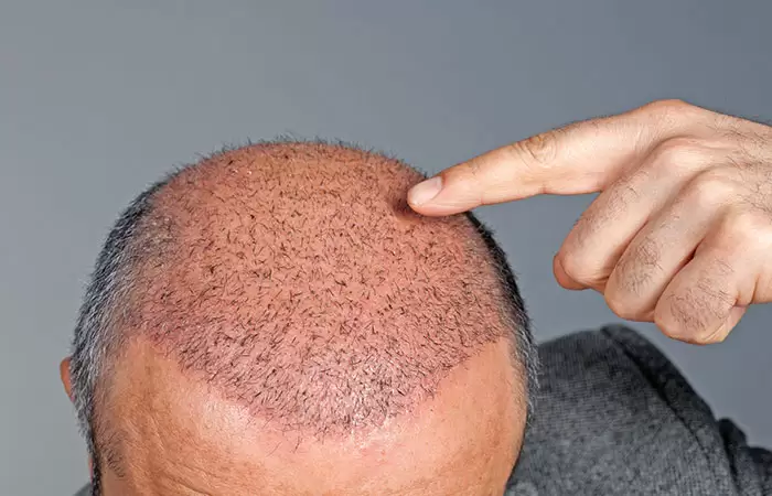 زراعة الشعر بالاستنساخ