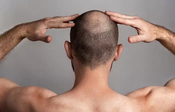 سعر عملية زراعة الشعر