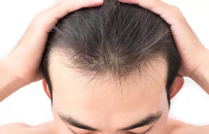 كم تكلفة زراعة الشعر