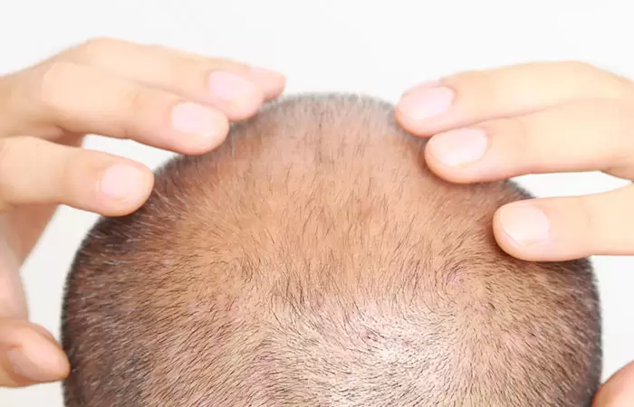 افضل مكان لزراعة الشعر