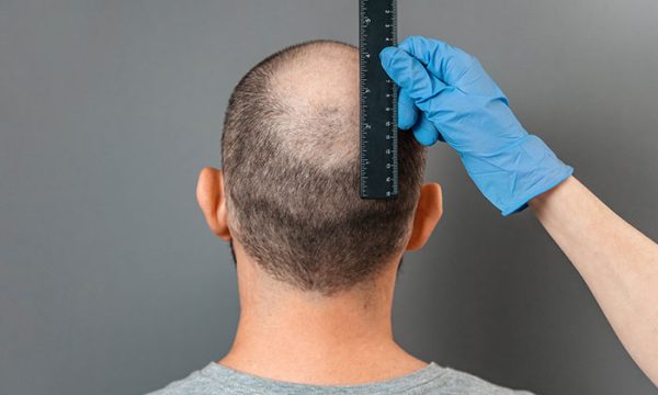 تجارب زراعة الشعر