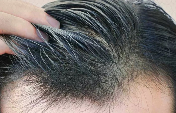 تكلفة عملية زرع الشعر