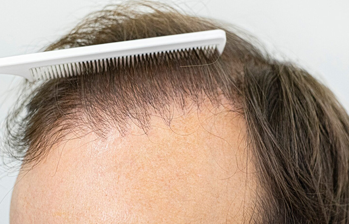كم تستغرق عملية زراعة الشعر