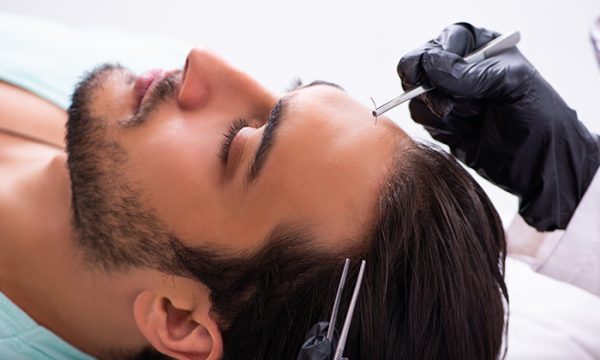 زراعة الشعر بتقنية الاقتطاف