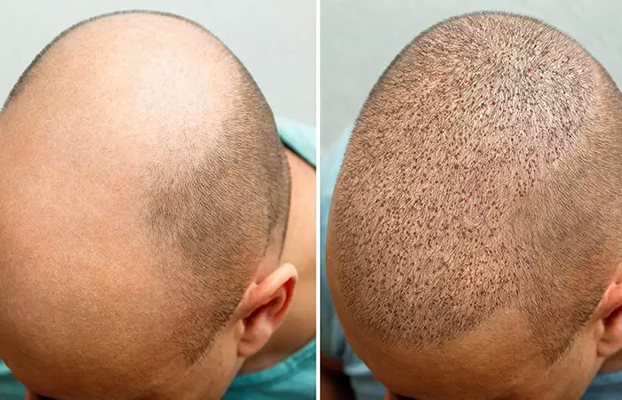 زراعة الشعر قبل وبعد