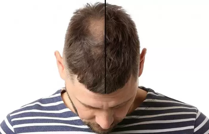 قبل وبعد زراعة الشعر الطبيعي