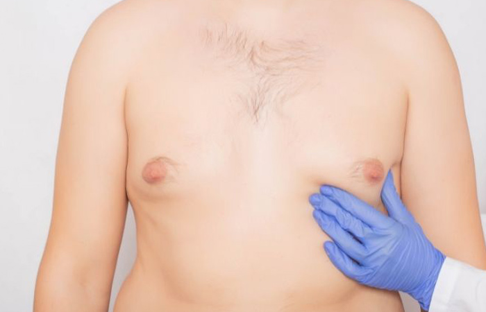 عملية شفط دهون الثدي للرجال