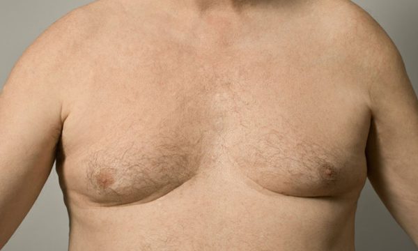 تصغير الثدي عند الرجال