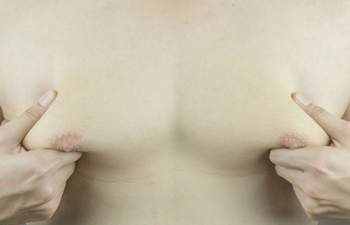 عمليات شفط دهون الثدي للرجال