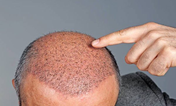 أضرار زراعة الشعر على المدى البعيد