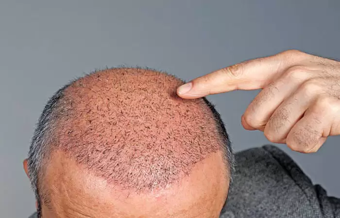 أضرار زراعة الشعر على المدى البعيد