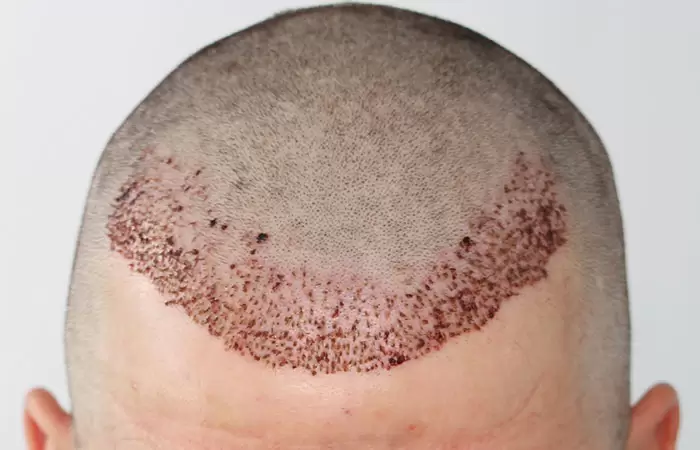 بعد 20 يوم من زراعة الشعر