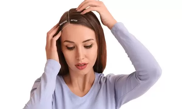 تكلفة زراعة الشعر للنساء في مصر