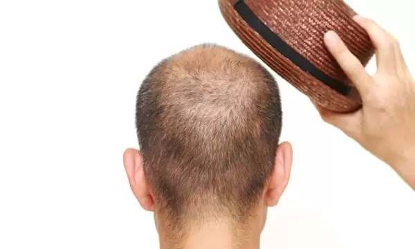 لبس القبعة بعد زراعة الشعر
