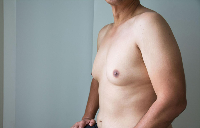 الفيزر لعلاج التثدي عند الرجال
