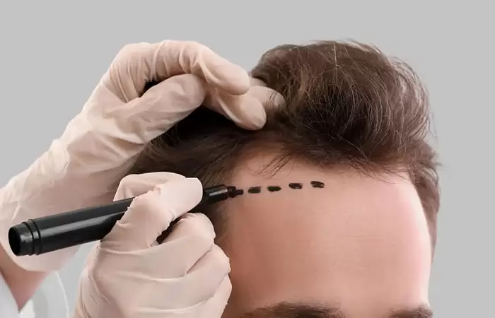 أحدث طرق زراعة الشعر بدون جراحة | إليك 5 أنواع