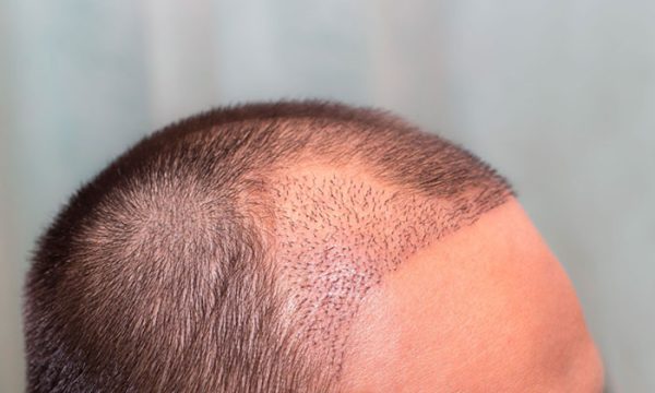 أفضل دكتور زراعة شعر