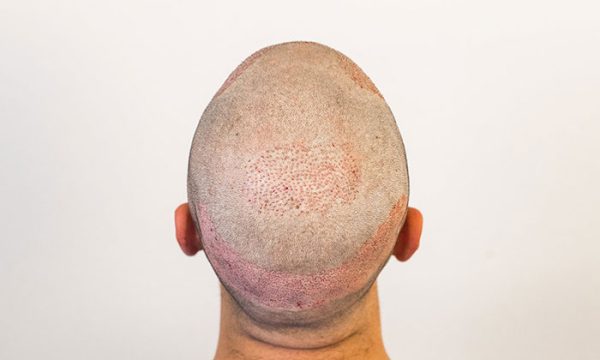 تساقط الشعر بعد زراعة الشعر