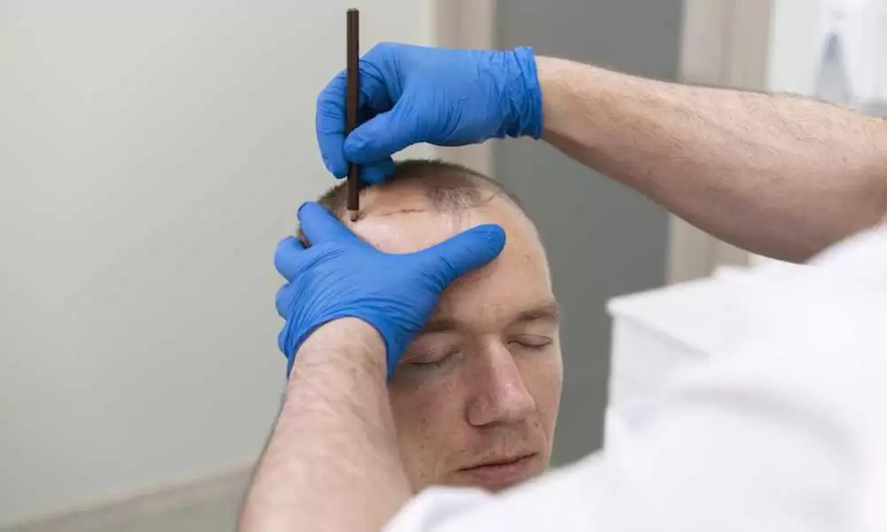 5 أسباب لـ تورم الوجه بعد عملية زراعة الشعر وعلاجه
