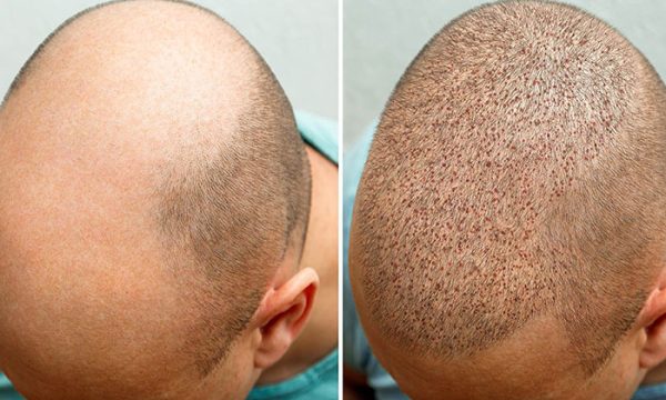 زراعة الشعر بعد شهرين