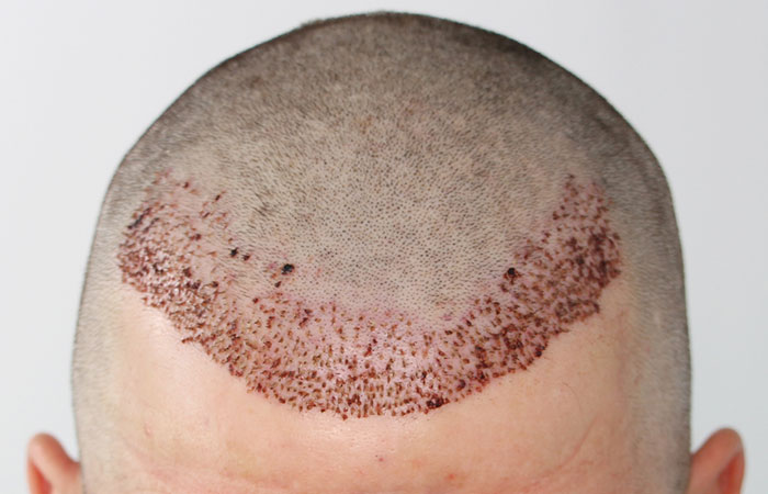 شكل الرأس بعد عملية زراعة الشعر