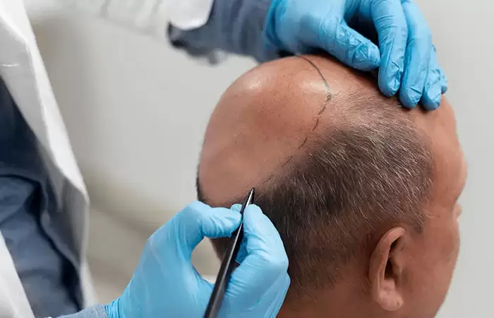 فوائد زراعة الشعر