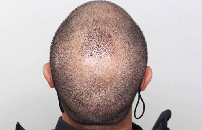 كيفية زراعة الشعر للرجال