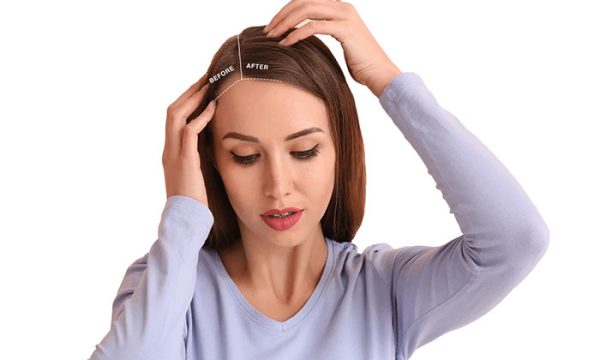 نتائج زراعة الشعر للنساء