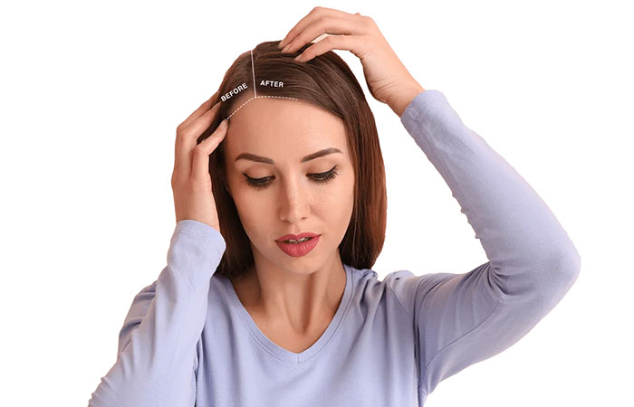 نتائج زراعة الشعر للنساء