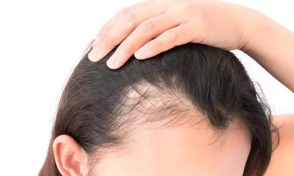 أفضل دكتور زراعة شعر الجبهة للنساء