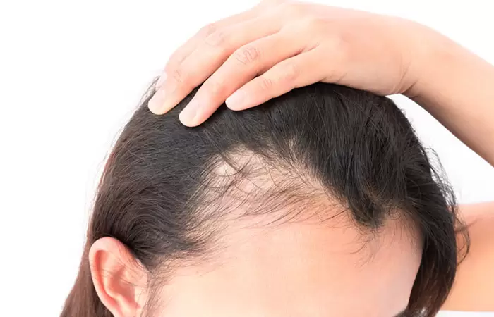 أفضل دكتور زراعة شعر الجبهة للنساء | 6 نصائح لاختياره