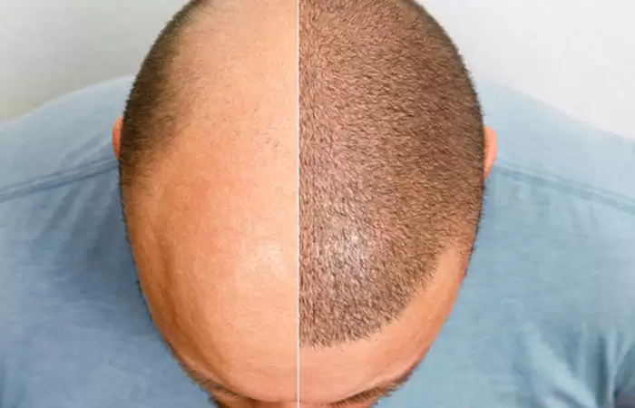 أفضل مركز زراعة شعر