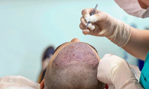 تكاليف زراعة الشعر في السعودية