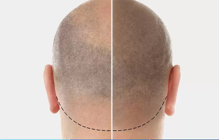 زراعة الشعر في دبي