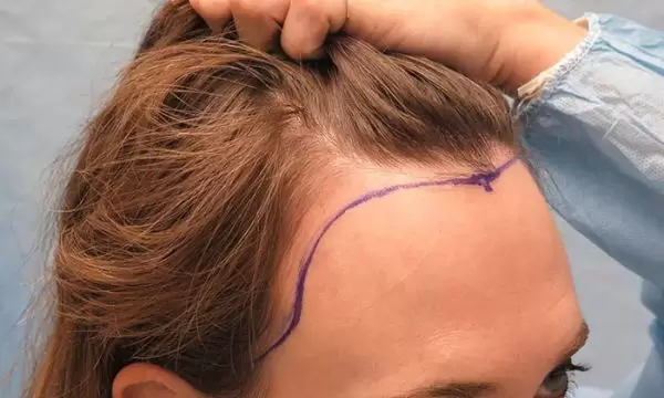 زراعة الشعر في مقدمة الرأس للنساء