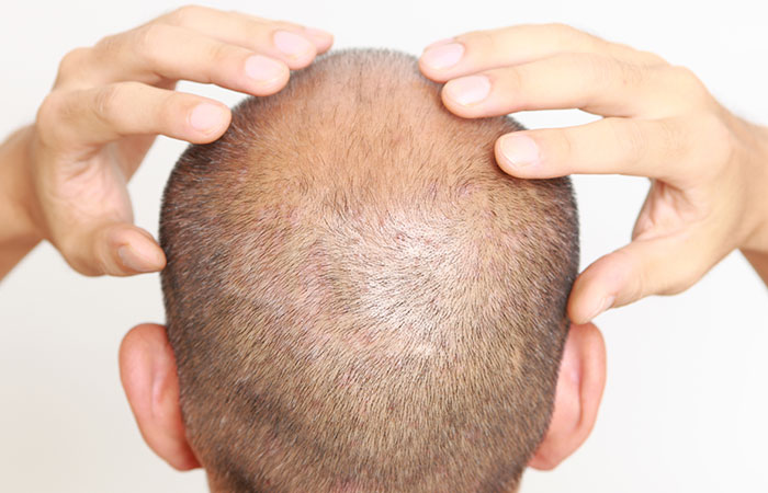 مضاعفات زراعة الشعر