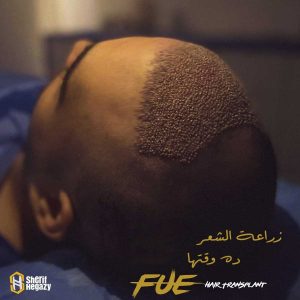 زراعة الشعر ده وقتها