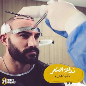 الخبرة فى زراعة الشعر الطبيعي