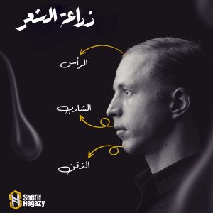 زراعة الشعر الطبيعي لدكتور شريف حجازي