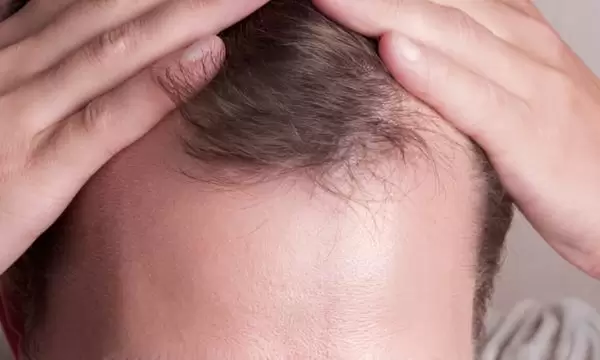 زراعة الشعر الخفيف